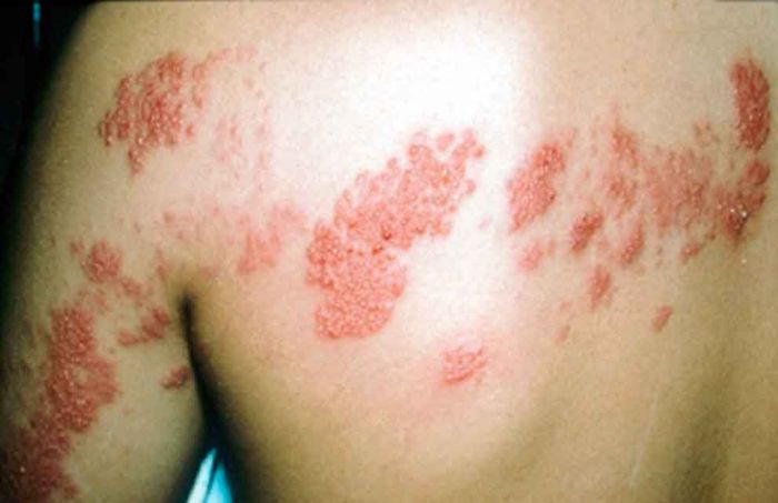 Perna na herpes sintomas simples